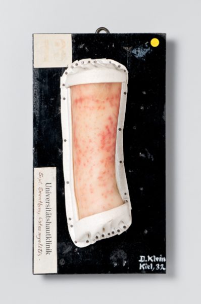 Sept. Exanthem, Osteomyelitis
