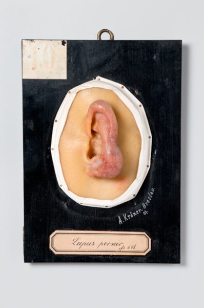 Lupus pernio
