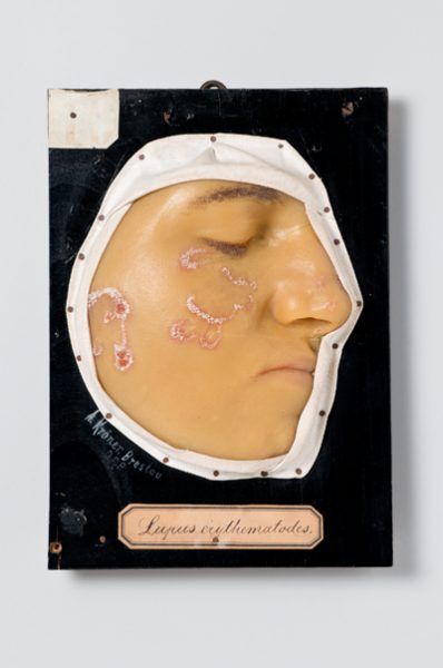 Lupus erythematodes.