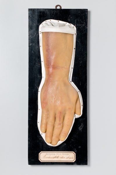 Acrodermatitis chron. atrophic.