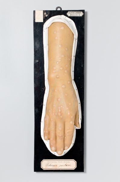 Urticaria perstans
