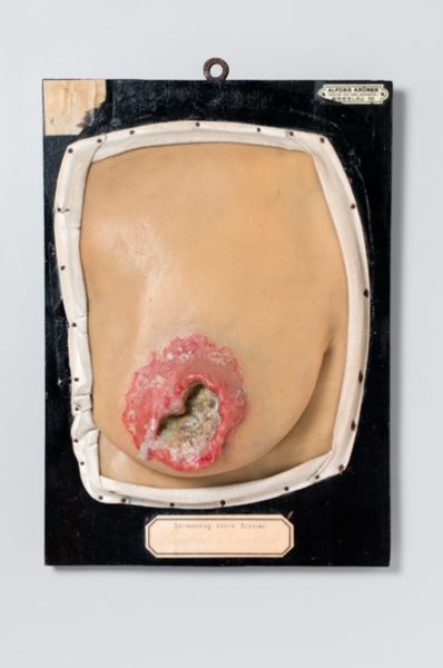 Paget'sche Krankheit