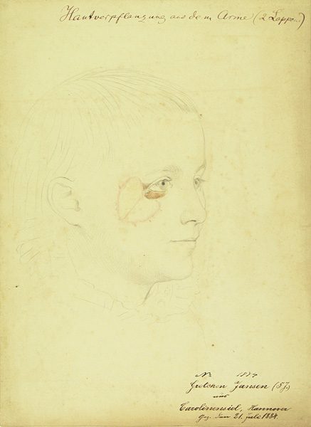 Hautverpflanzung aus dem Arm. Krankenbildnis Gretchen Jansen