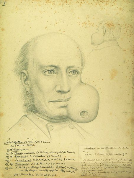 Spindelzellen-Sarkom. Krankenbildnis J.F. Boller